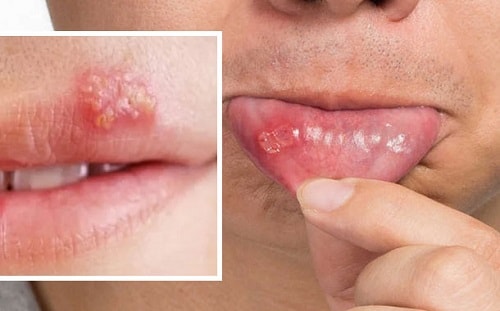 dấu hiệu nhiễm hpv ở miệng