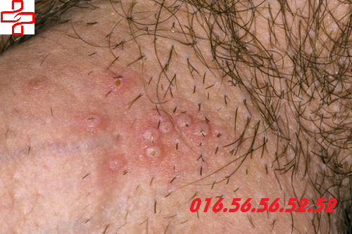 viêm da bìu do herpes sinh dục viêm da bìu do herpes sinh dục