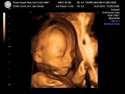 hình ảnh siêu âm thai nhi 22 tuần tuổi