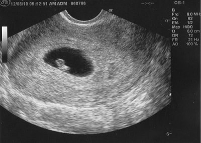hình ảnh siêu âm thai 5 tuần tuổi