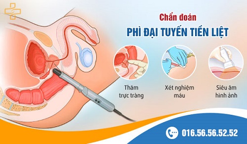 khám phì đại tiền liệt tuyến ở đâu hà nội khám phì đại tiền liệt tuyến ở đâu hà nội