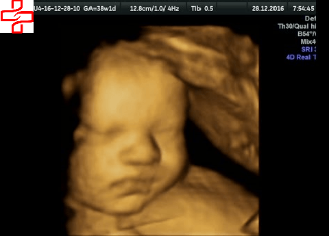 Với chuẩn siêu âm 4D, bạn sẽ được trải nghiệm khả năng hiển thị hình ảnh rõ nét, sắc nét, giúp bạn nhìn rõ hơn những đặc điểm của một đứa bé và có những ngày mong chờ tràn đầy niềm vui trước khi bé ra đời.