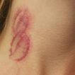 vet-can-hickey-co-nguy-hiem-khong