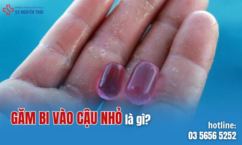 Găm bi vào cậu nhỏ là gì?