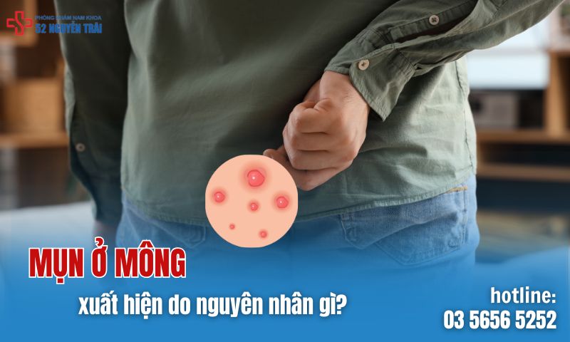 Mụn ở mông xuất hiện do nguyên nhân gì?