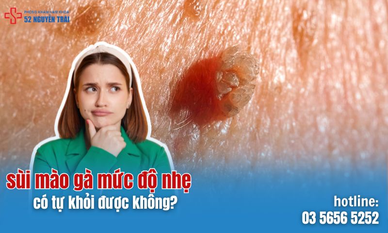 Sùi mào gà nhẹ nếu không điều trị có thể tự khỏi không?