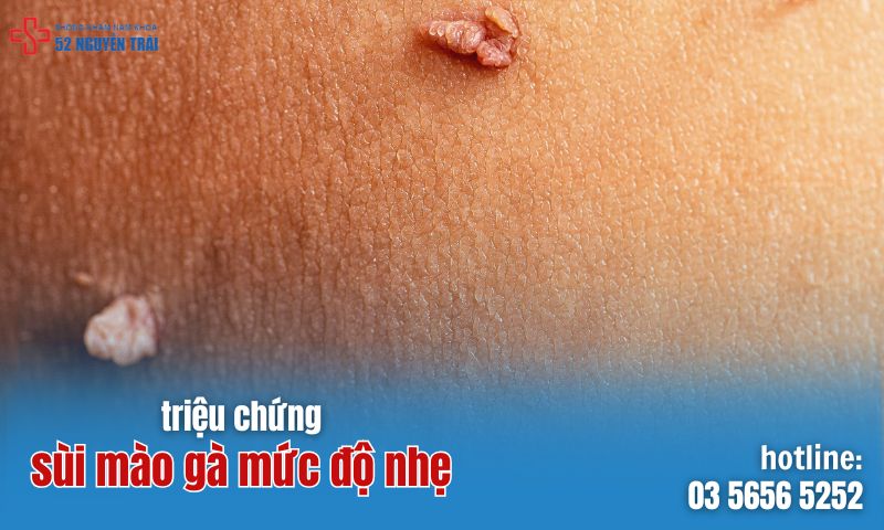 Triệu chứng sùi mào gà nhẹ?