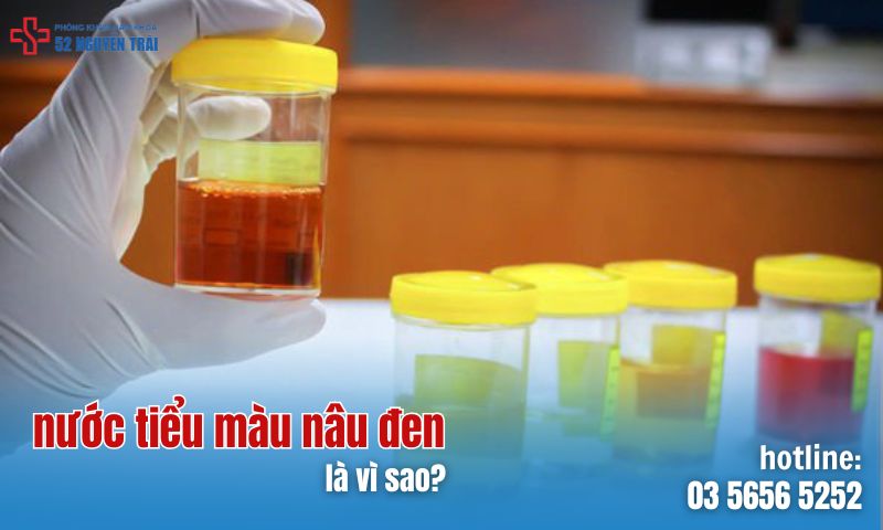 Nước tiểu màu nâu đen là bị gì?