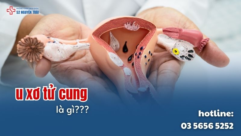 U xơ tử cung là gì?