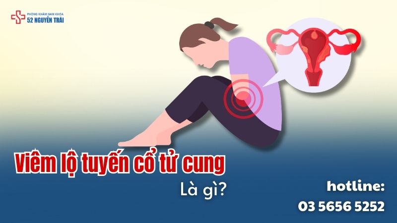 Viêm lộ tuyến cổ tử cung là gì?