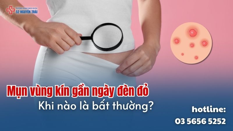 Mụn vùng kín gần ngày đèn đỏ – Khi nào là bất thường?