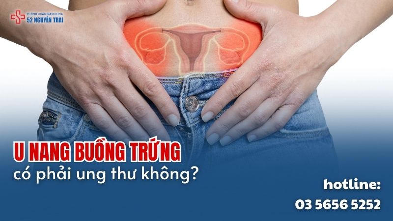 U nang buồng trứng có phải ung thư không?